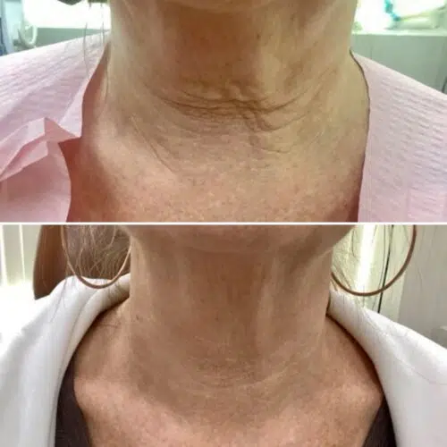 Before & After Neck