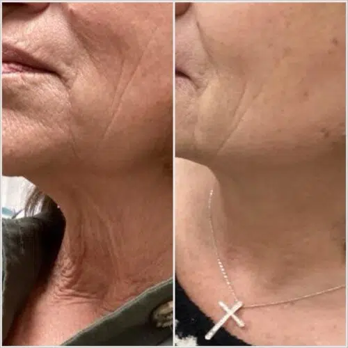 A closeup photo showing the before and after results of a non-surgical neck restoration