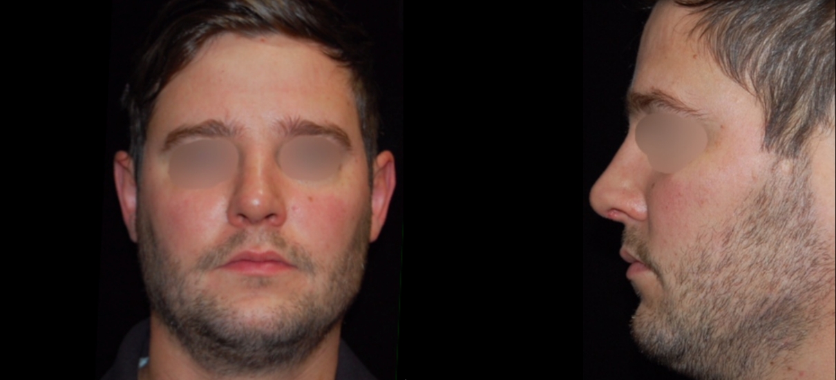 Rhinoplasty 1 Patient1 Set1 After