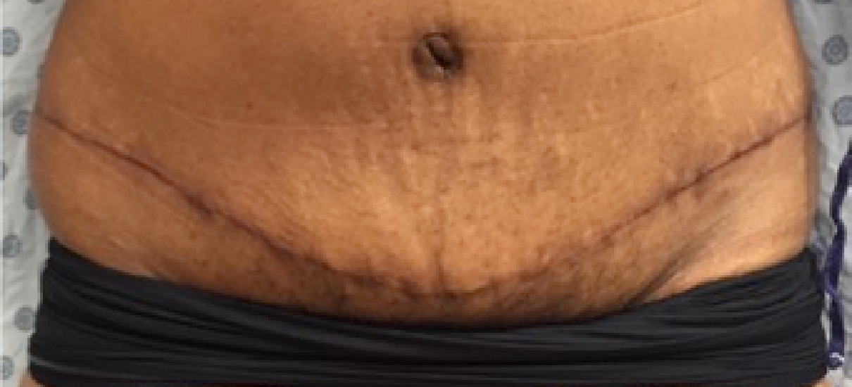 Tummy Tuck (Abdominoplasty) Patient 7 Patient1 Set1 After