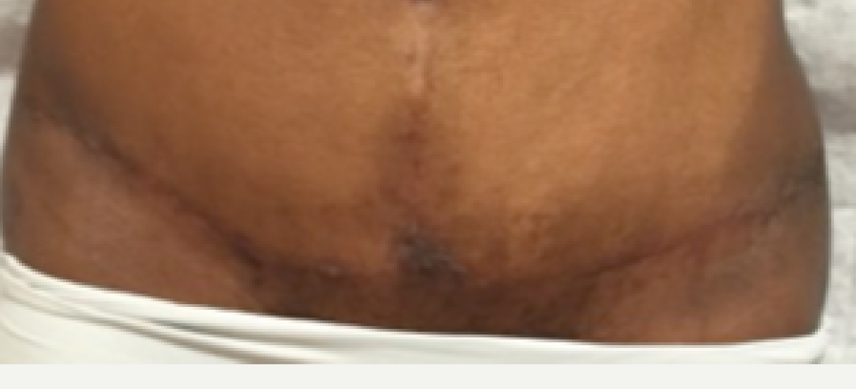 Tummy Tuck (Abdominoplasty) Patient 8 Patient1 Set1 After