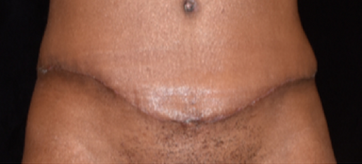 Tummy Tuck (Abdominoplasty) Patient 9 Patient1 Set1 After