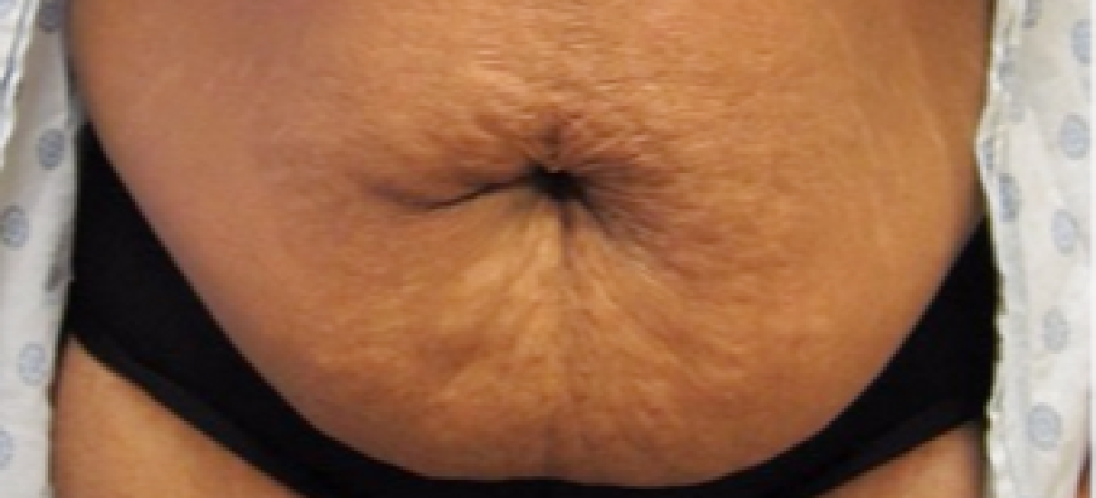 Tummy Tuck (Abdominoplasty) Patient 7 Patient1 Set1 Before Page