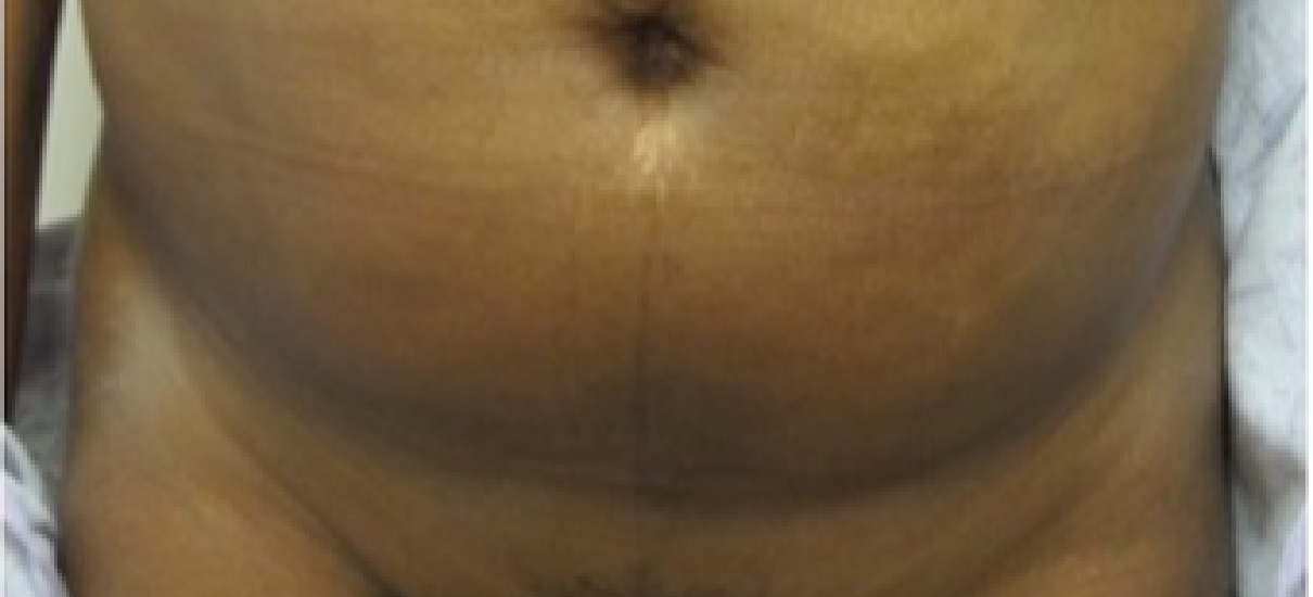 Tummy Tuck (Abdominoplasty) Patient 8 Patient1 Set1 Before Page