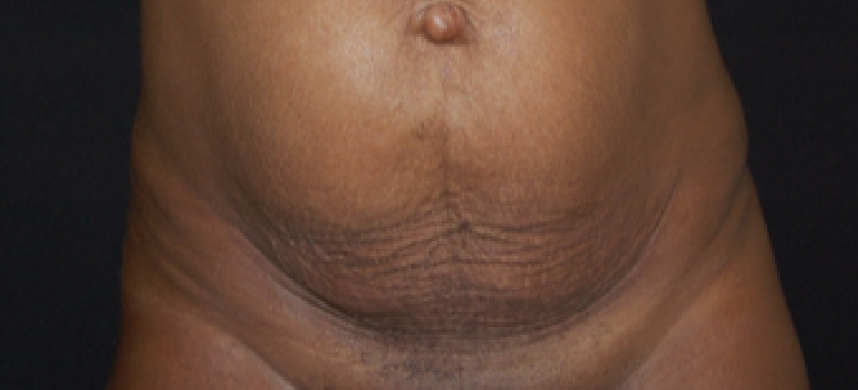 Tummy Tuck (Abdominoplasty) Patient 9 Patient1 Set1 Before