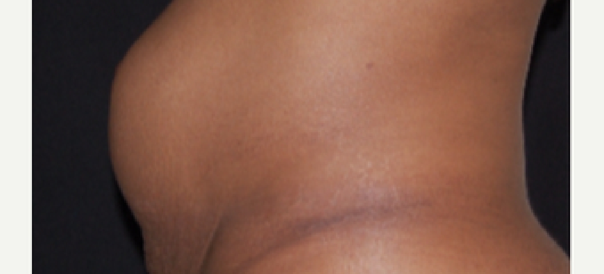 Tummy Tuck (Abdominoplasty) Patient 10 Patient1 Set1 Before