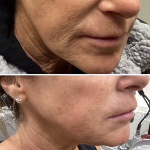 Restylane and Skinvive