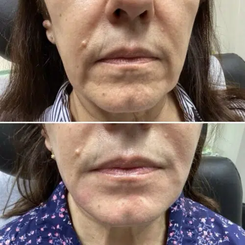 Before & After Restylane