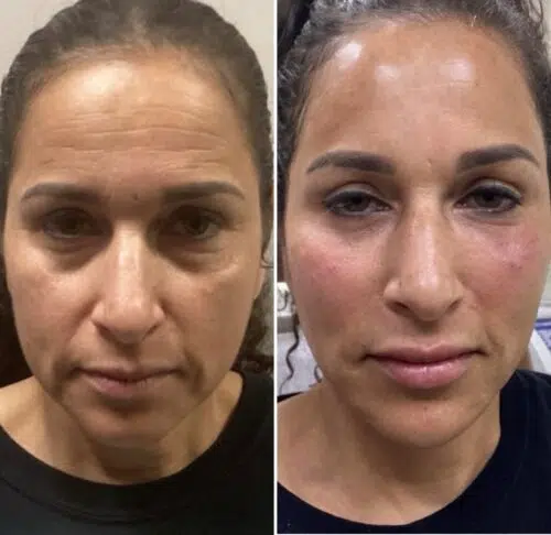 Before & After Liquid lift