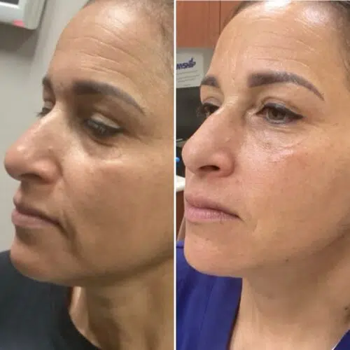 Before & After Liquid lift