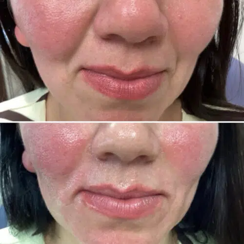 Face lift