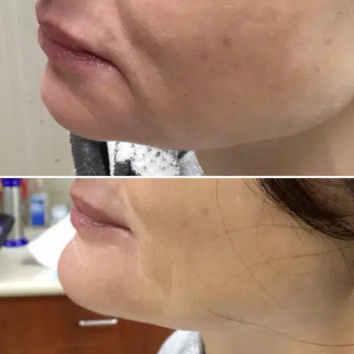 Chin surgery
