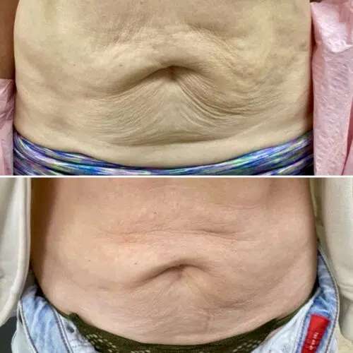 Before & After Softwave