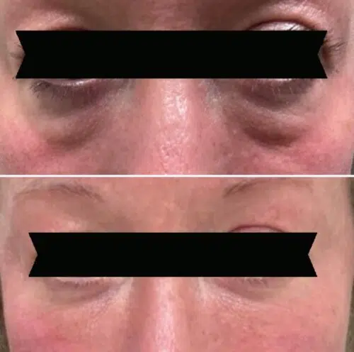 Before-and-after close-up comparison of a patient's eyes after tear trough filler or plastic surgery. The top image (before) shows prominent dark circles and hollowing under the eyes, while the bottom image (after) shows a smoother, filled-in appearance with reduced darkness and hollowing.