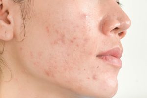 What is the best treatment for inflammatory acne?
