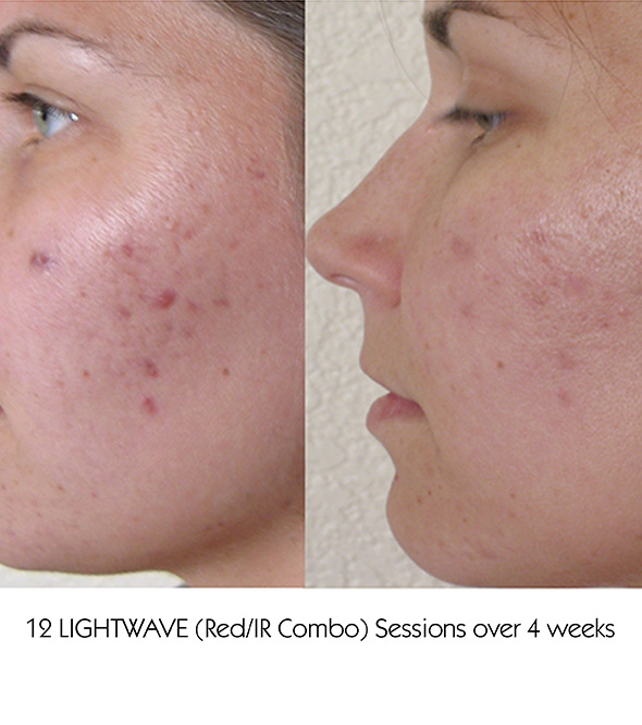 ACNE AND ACNE SCARRING TREATMENTS IN OSSINING, NY Service Photo2