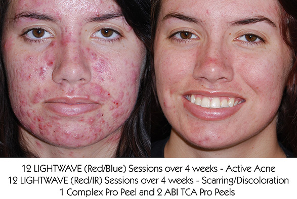 ACNE AND ACNE SCARRING TREATMENTS IN OSSINING, NY Service Photo3