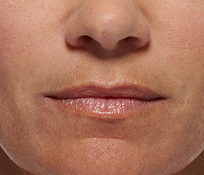 BELOTERO-BALANCE patient after photo
