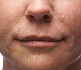 BELOTERO-BALANCE patient after photo