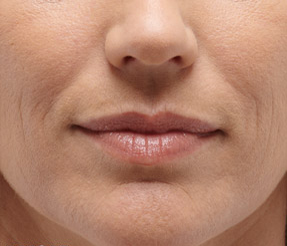 BELOTERO-BALANCE patient before photo