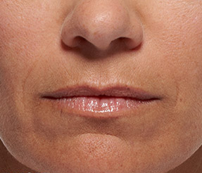 BELOTERO-BALANCE patient before photo