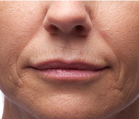 BELOTERO-BALANCE patient before photo