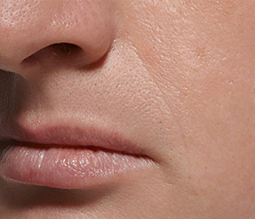 BELOTERO-BALANCE patient after photo