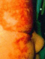 Broken Blood Vessels woman patient before photo