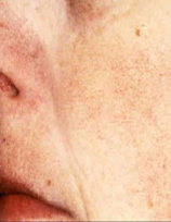 Broken Blood Vessels woman patient after photo