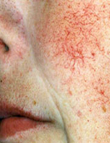 Broken Blood Vessels woman patient before photo