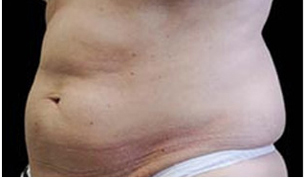 CoolSculpting patient before photo