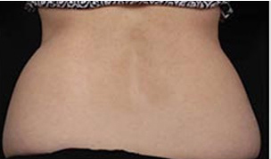 CoolSculpting patient before photo