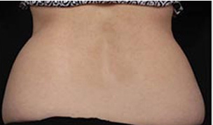 CoolSculpting patient before photo