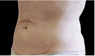 CoolSculpting patient after photo