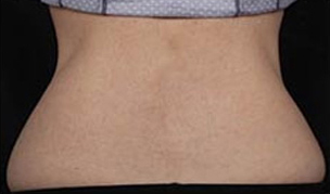 CoolSculpting patient after photo