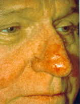 Broken Blood Vessels woman patient before photo
