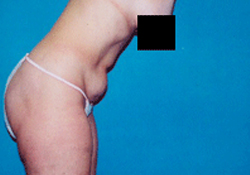 Liposuction patient before photo