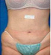 Zerona patient after photo