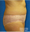 Zerona patient after photo