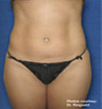 Zerona patient after photo