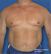 Zerona patient after photo