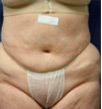 Zerona patient before photo