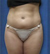 Zerona patient before photo