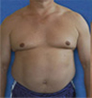 Zerona patient before photo