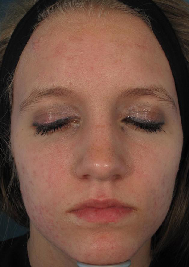 ACNE: AFTER RESULTS WITH ACLEARA LASER