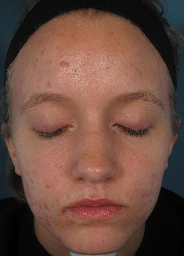 ACNE: BEFORE RESULTS WITH ACLEARA LASER