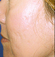 Scars patient after photo