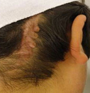 Scars patient after photo