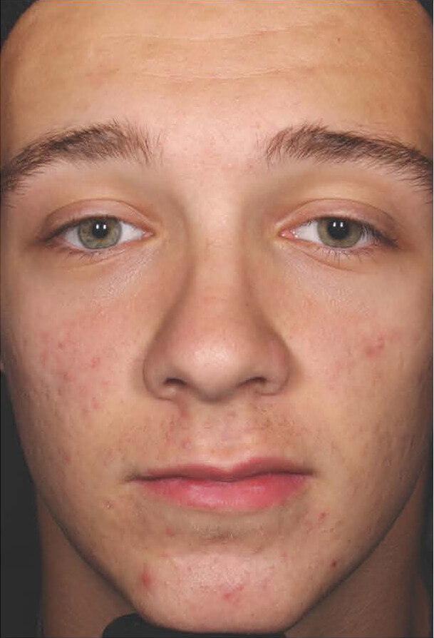 Aczone gel man patient after photo