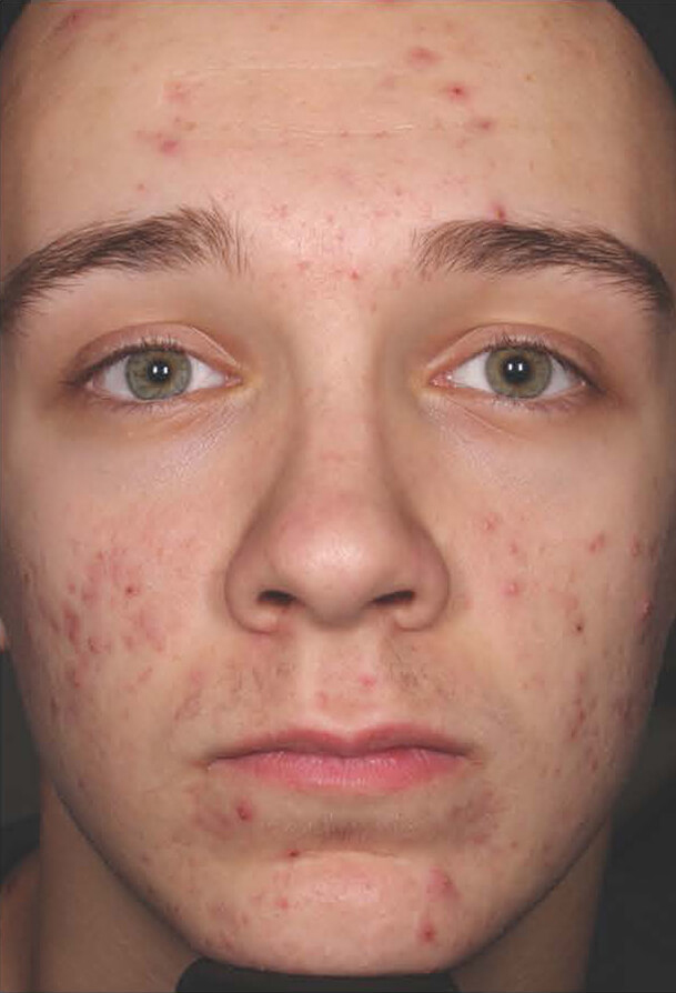 Aczone gel man patient before photo